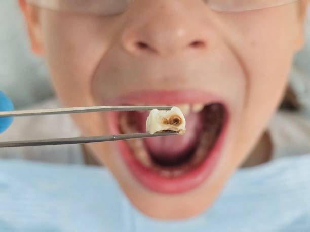 Best Tooth Infection Emergency Dentist  in Riverview, FL